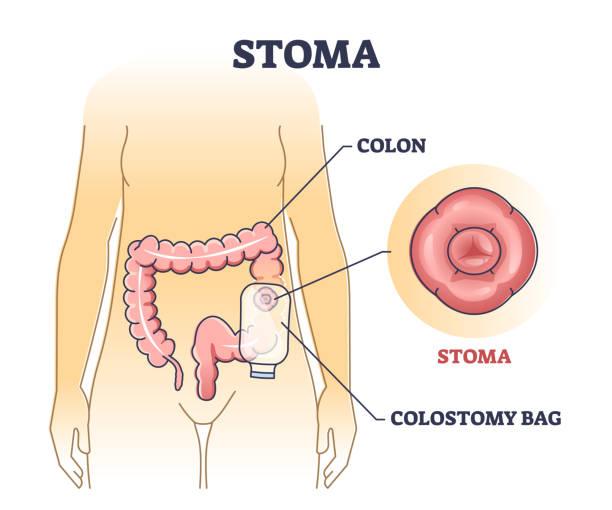 Daily life guidance for stoma patients at home - HEAGI - Colostomy bags Supplies