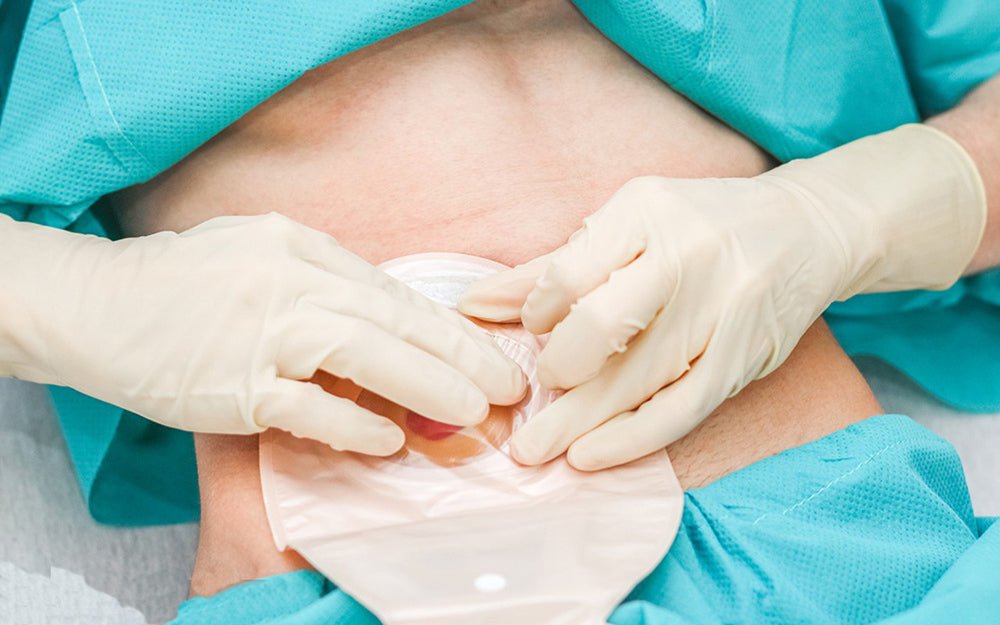 Prevent Colostomy Bag Ballooning and Odor - HEAGI - Colostomy bags Supplies