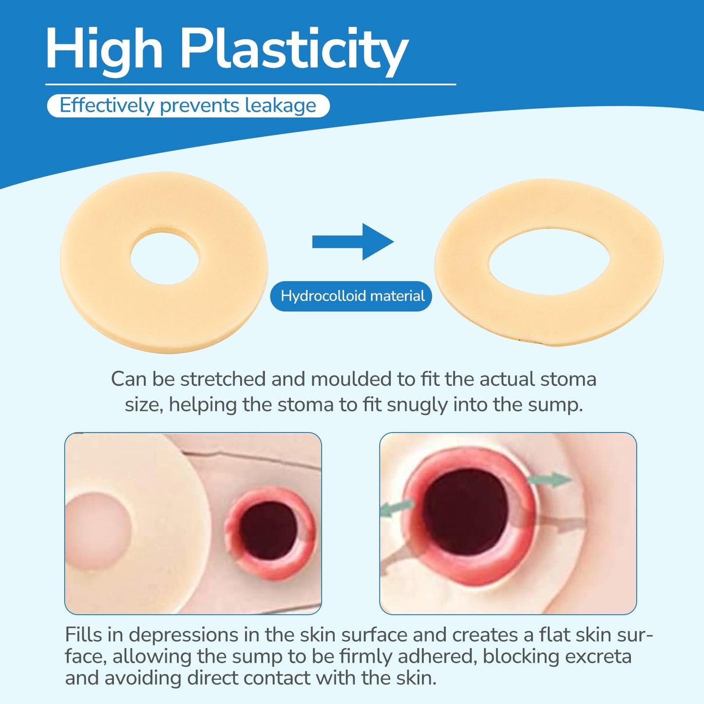 HEAGI Ostomy Barrier Rings Ostomy Supplies 4mm Thickness Moldable Ostomy Rings Medical Grade Hydrocolloid Adhesive - HEAGI - Colostomy bags Supplies