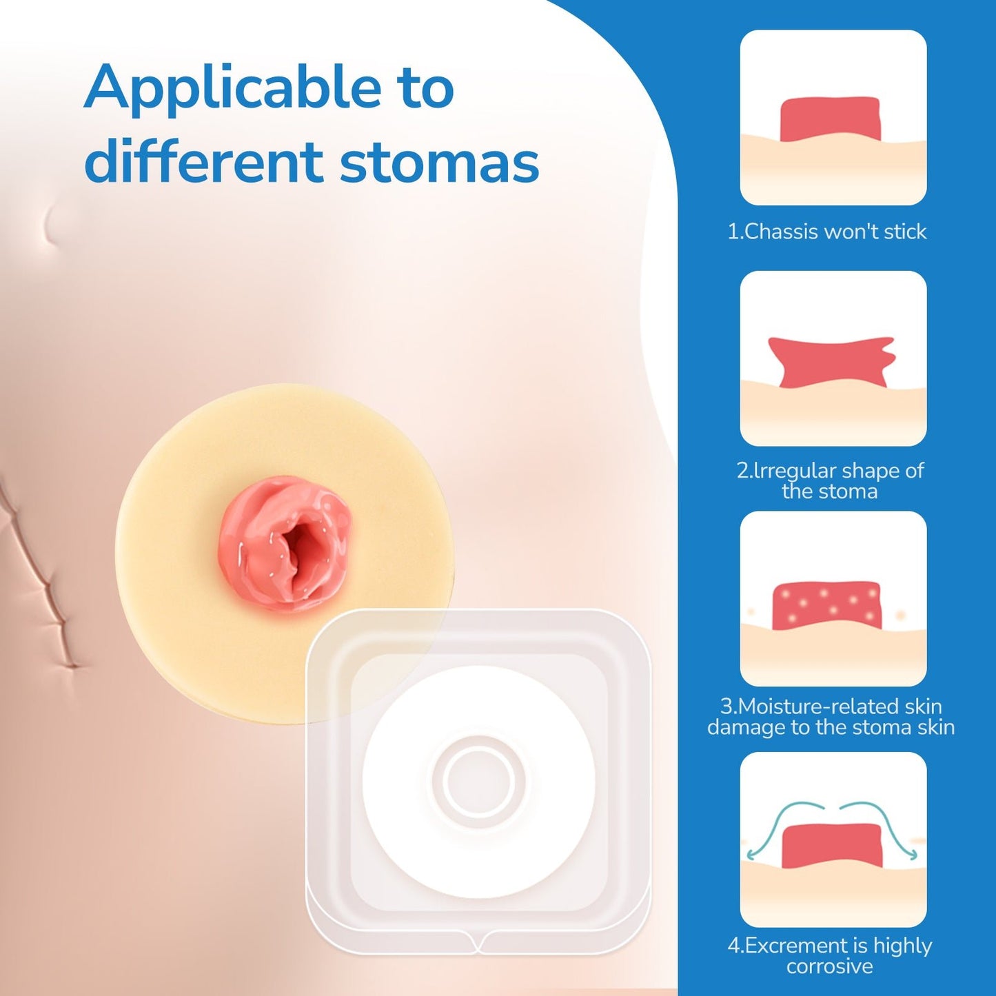 HEAGI Ostomy Barrier Rings Ostomy Supplies 4mm Thickness Moldable Ostomy Rings Medical Grade Hydrocolloid Adhesive - HEAGI - Colostomy bags Supplies
