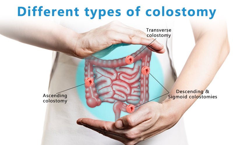 Different Colostomy Types Colostomy Types: Locations and Care Needs – HEAGI - Colostomy bags Supplies