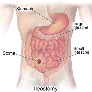 Prevention and treatment of parastomal hernia - HEAGI - Colostomy bags Supplies